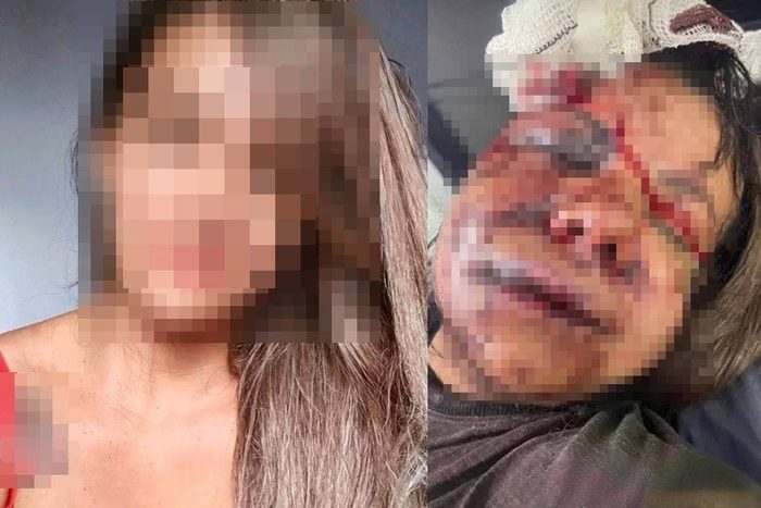 mulher com rosto desconfigurado após agressão de Igor Cabral em Natal