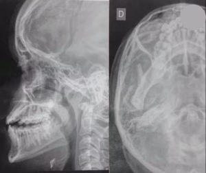 Fratura no nariz e dentes quebrados de adolescente agredido dentro da escola