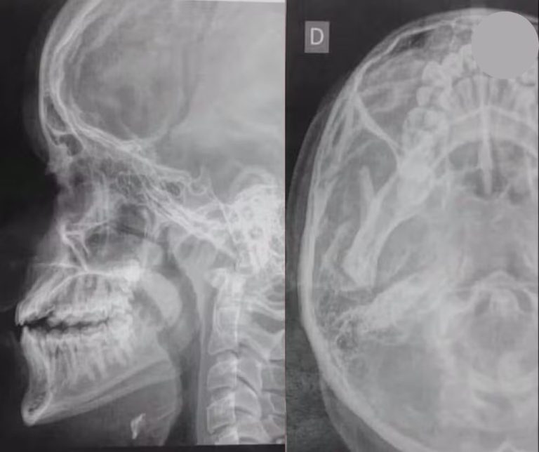 Fratura no nariz e dentes quebrados de adolescente agredido dentro da escola