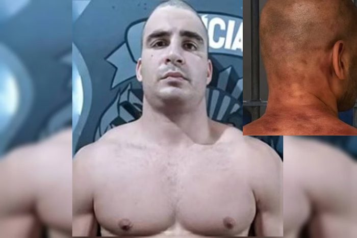Marcas nas costas de Igor Eduardo Cabral após agressão em presídio no RN
