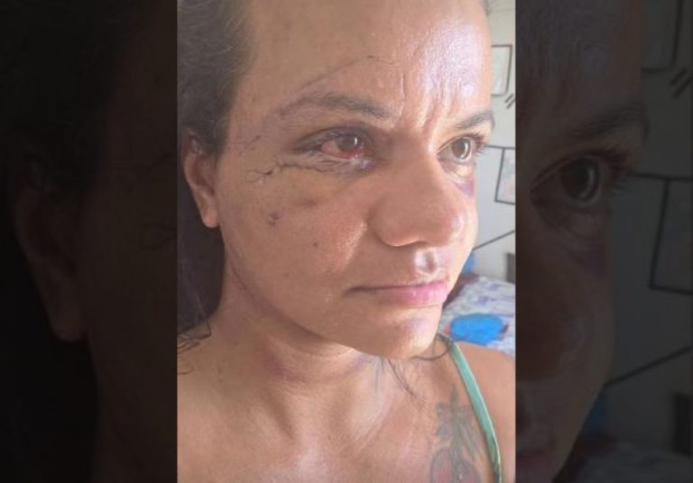 Juliana Soares mostra rosto após reconstrução facial por agressão